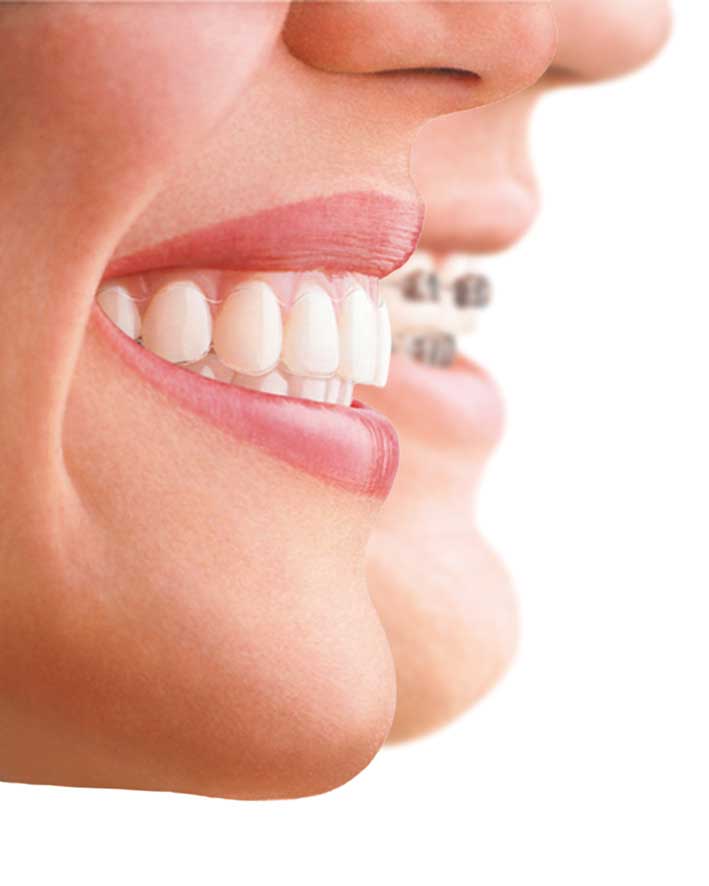 5 Benefits of Invisalign