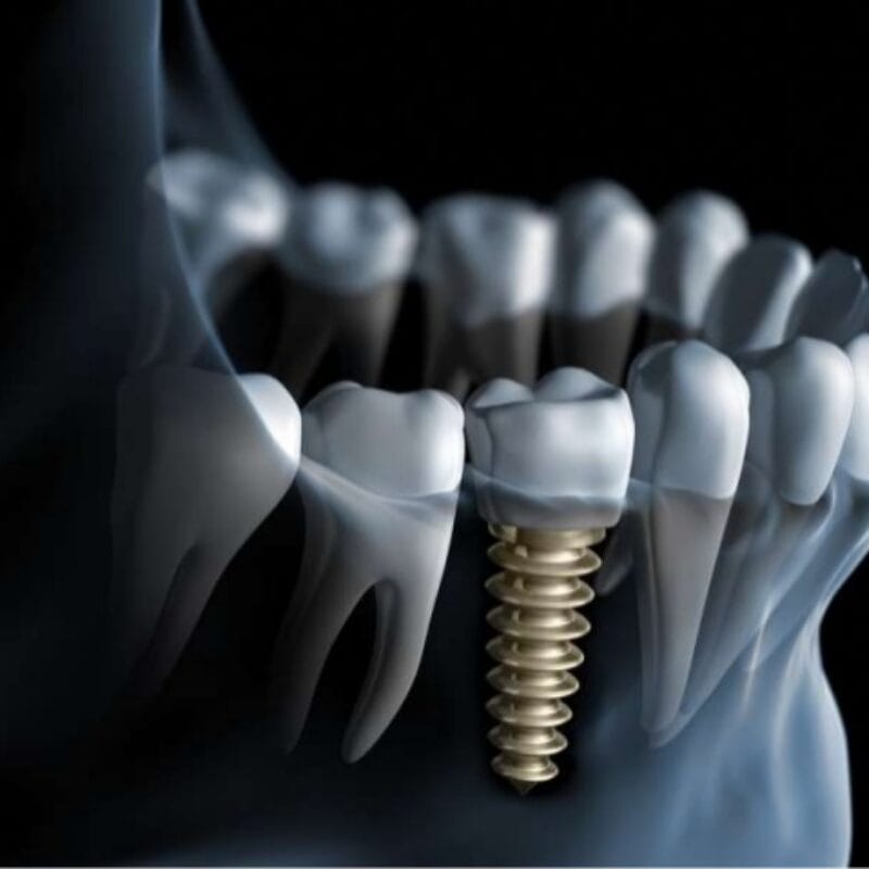 dental-implants-free-consultation- - Boston House Healthcare LLP